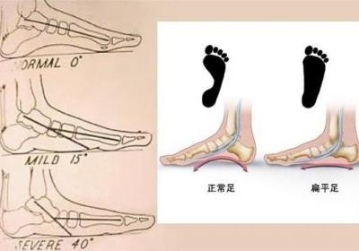 扁平足能跑步吗？扁平足跑步有什么危害？如何矫正