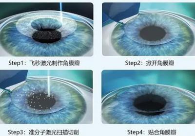 近视手术大概多少钱，近视手术价格一览表原创