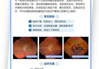 郑州普瑞眼科专家揭示：外卖奶茶与糖网病致盲风险